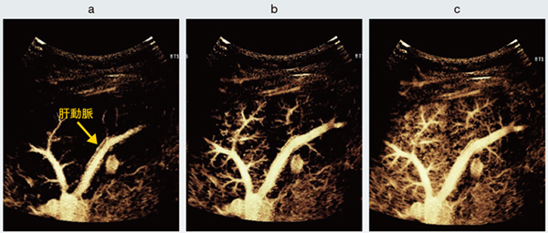 図1　正常肝実質のSuper Resolution MVI画像