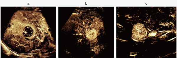図2　Super Resolution MVIによる肝腫瘍の血管構築パターン
