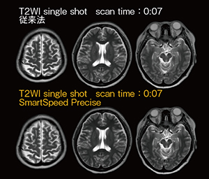 図1　SmartSpeed Preciseによる画質向上 SmartSpeed Preciseでは，single shotによる7秒スキャンで十分なコントラストと鮮鋭度，リンギングアーチファクトが低減された画像が得られている。