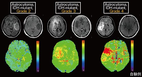 図2　ATP強調画像によるグリオーマの悪性度評価 Astrocytoma，IDH-mutant，grade 2，3，4では，gradeが高くなるほど信号が高くなっている。