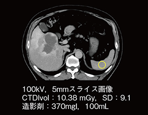 腹部造影CT（造影平衡相，体重90kg） 線量・造影剤を低減してもPrecise Imageでノイズの少ない明瞭な画像を取得