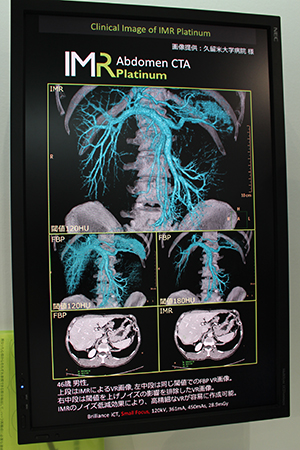 IMR Platinumのノイズ低減効果で，閾値を下げても末梢血管まで描出できる。