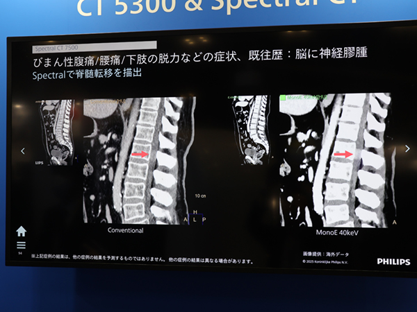 「Spectral CT 7500」のスペクトラルイメージングにより脊髄転移を明瞭化