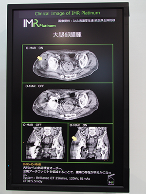 “O-MAR”を併用した大腿部膿腫の臨床画像