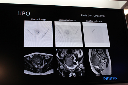 拡散強調画像に現れやすいアーチファクトを低減する“LIPO”