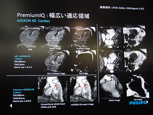 心電図同期も併用できる脂肪抑制“mDIXON XD”