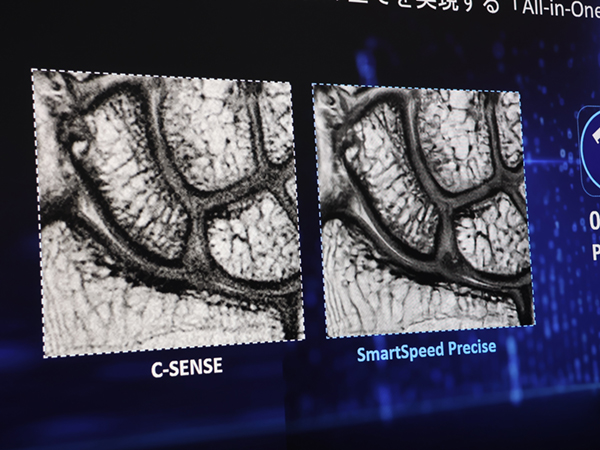 MRIの高速化と高画質化を革新する「SmartSpeed Precise」（右）