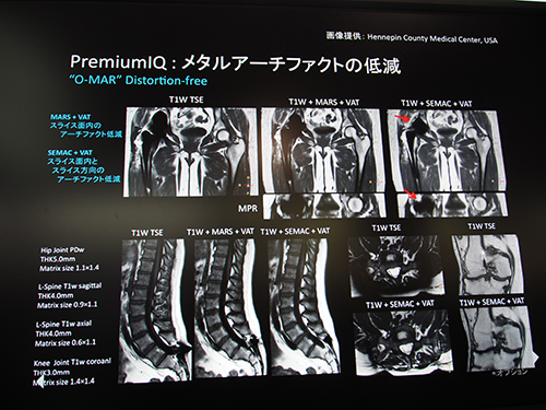 スライス方向の金属アーチファクトも低減する“O-MAR”