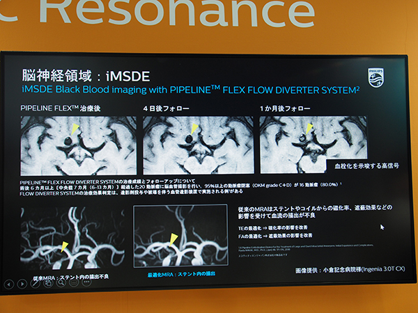 フローダイバーターステント治療の効果判定に有用な脳神経領域の“iMSDE”