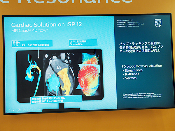 カラーマップで血流を可視化する“MR Caas 4D flow”