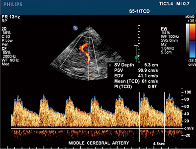 図2　経頭蓋超音波ドプラ（TCD）検査におけるHigh Q計測例（MCA領域）