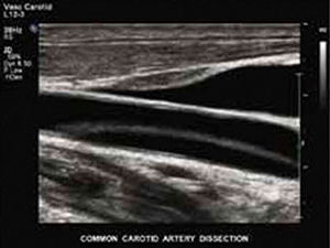図8　nSIGHTイメージングによる総頸動脈の解離疾患例