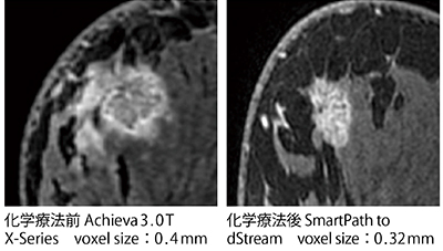 図2　SmartPath to dStream前後の同一患者の画質比較 （画像ご提供：北福島医療センター・丹治　一先生）