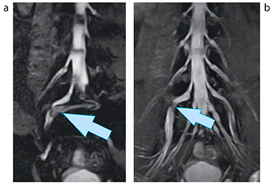 図5　3D SHINKEIによる腕神経叢（a），腰部神経叢（b）のMR neurography