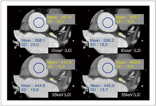 図5　同一患者のiDose4と55keV画像の比較 （画像ご提供：熊本中央病院様）
