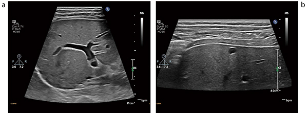 図2　eL18-4の腹部画像 a：深さ11cm。50mmの口径とトラペゾイドを使用することで広い領域の描出が可能。 b：深さ4cm。肝表面における多重反射の影響が少なく，シストも認識しやすい。