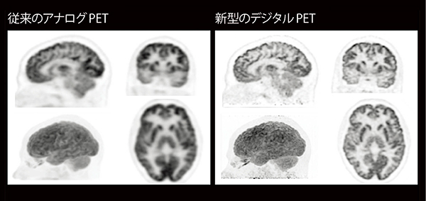 図4　アナログPET画像とデジタルPET画像の比較（頭頸部）