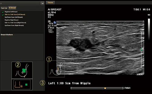 図3　AI Breast機能 (1)プローブマークの自動追従，(2)走査軌跡のペイント，(3)乳頭腫瘤間距離のワンボタン表示