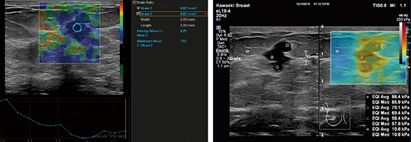図1　乳腺悪性病変例 ストレイン画像（左）では病変が周囲より青く表示されており，strain ratioは平均6.25，最大7.23で硬い腫瘍として描出されている。シアウェーブ・エラストグラフィ（右）では，腫瘤部が硬く（赤色）表示され，最大88.4kPaと硬い腫瘍であることがわかる。 （画像ご提供：川崎医科大学・中島一毅先生）