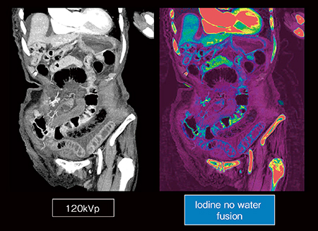 図6　非閉塞性腸管虚血（NOMI） ヨード密度強調画像のフュージョン画像（右）では腸管の正常範囲と虚血の範囲を明瞭に抽出 （画像ご提供：苫小牧市立病院様）