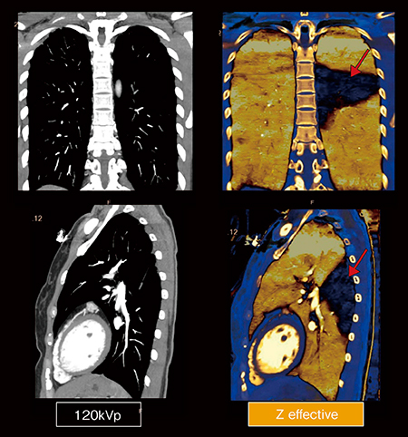 図7　慢性肺動脈塞栓 実効原子番号画像（右）によりS6区域の血流低下が明瞭に抽出された（←）。 （画像ご提供：札幌心臓血管クリニック様）