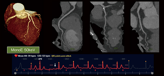 図9　腎機能低下患者に対する冠動脈精査 腎機能低下のため，MonoE 50keV画像を用いて造影剤使用量9mL （画像ご提供：みなみの循環器病院様）
