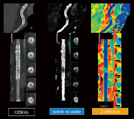 図10　スペクトラルイメージングによるステント内腔の抽出 （画像ご提供：みなみ野循環器病院様）