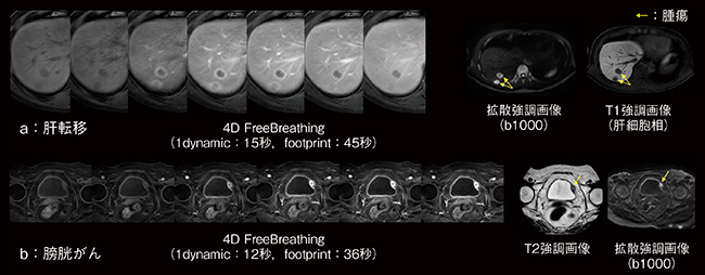 図4　4D FreeBreathingを用いて自由呼吸下で撮像された臨床例 （画像ご提供：熊本中央病院様）