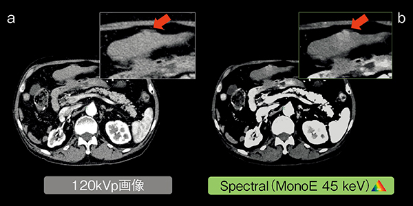 図2　肝転移症例 a：120kVp画像 b：MonoE（45keV）