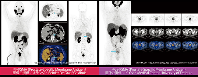 図4　前立腺領域におけるPSMAイメージングの例（国内未承認放射性医薬品）