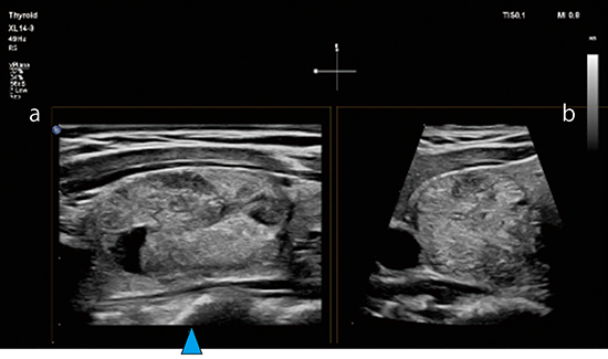 図4　リアルタイム直交断面機能Live xPlaneで描出された甲状腺 aが描出断面，bはそれに対して▲部分を通る直交断面