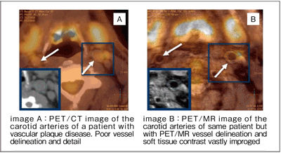 図3　Ingenuity TF PET/MRによる血管内プラーク画像