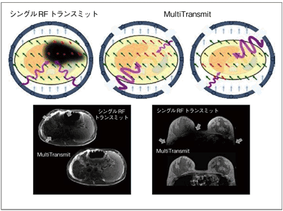 図6　3T MRI装置におけるMultiTransmit技術