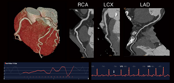 図6　多様な心拍に対応する画像再構成技術 平均HR 96bpm（Af：心拍変動幅60〜125bpm） （画像ご提供：みなみ野循環器病院様）