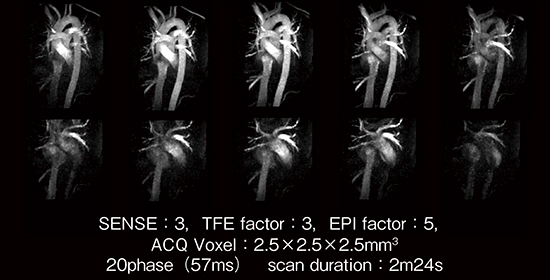 図2　Retrospective EPIを併用した4D flow画像 高時間分解能，高空間分解能で撮像しているが，EPI factorを5と設定することで2分24秒と短時間での撮像が可能。（20phase撮像したうちの10phaseのみを表示） （画像ご提供：北海道大学病院様）