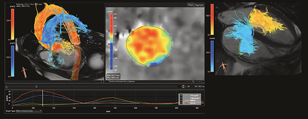 図4　‌ISPによる4D flow MRIの解析画面