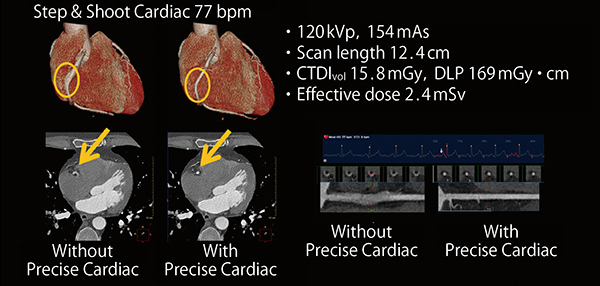 図2　Precise Cardiac（77bpm，コンベンショナル撮影）