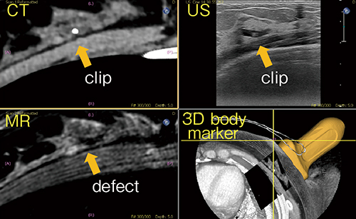 図2　MRIやCTの画像とfusionすることでマーカーとして埋め込みされたclipも簡単に探すことが可能（画像ご提供：朝日大学病院）