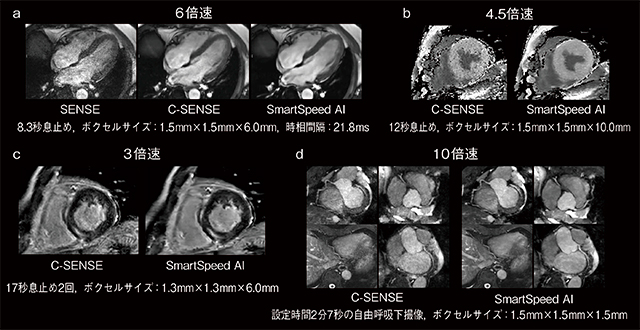 図4　SmartSpeed AIの循環器領域への応用例 シネ（a），T1マップ（b），遅延造影（c），whole heart冠動脈（d）撮像におけるSENSE，C-SENSE，SmartSpeed AIの比較。SmartSpeed AIでは高いSNRが保持されている。 （画像ご提供：東京警察病院様）