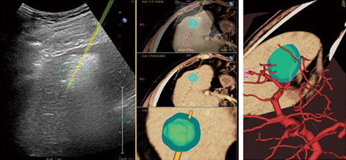 図3　RFA治療中にUS画面上に表示される3D腫瘍 輪郭マーカーとNeedle Trackerによる仮想針 （画像ご提供：岩手医科大学病院・黒田英克先生）