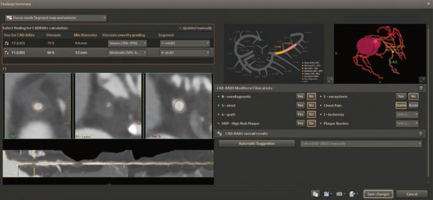 図2　CAD-RADSによる狭窄評価レポート
