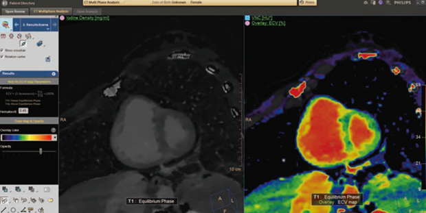 図3　CT Multi Phase AnalysisによるCT遅延像によるECV解析