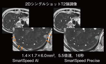 図2　SmartSpeed AIとSmartSpeed Preciseの臨床応用例（肝臓） （画像ご提供：熊本中央病院）