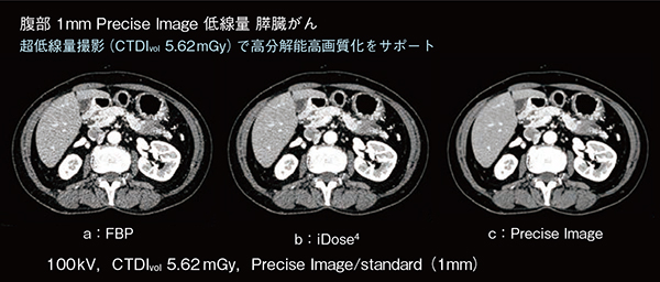 図1　従来FBP画像（a），逐次近似応用再構成画像（iDose4：b）とPrecise Image（c）による腹部CT画像比較
