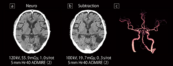 myExam Companionの適用例：頭部CT検査における撮影条件の変更