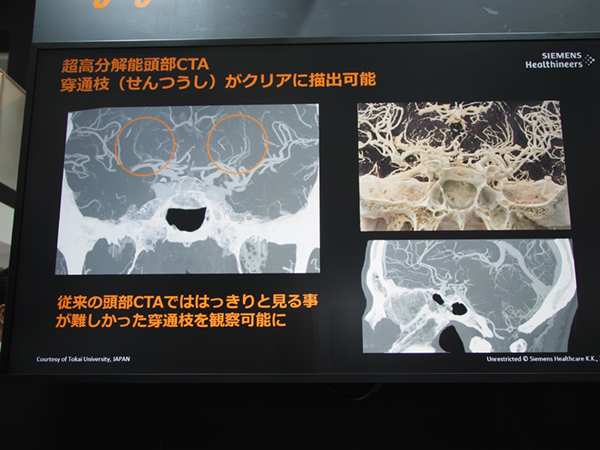 高空間分解能により頭部CTAでは穿通枝の観察が可能