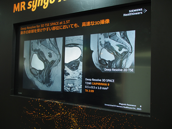 Deep Resolveと3D SPACE，CAIPIRINHAを組み合わせて高速な3D撮像を実現