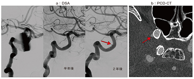 図1　症例1：ステント外側の残存血流の評価
