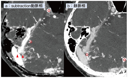 図5　症例4：PCD-CTによるテント部dAVFの静脈の評価