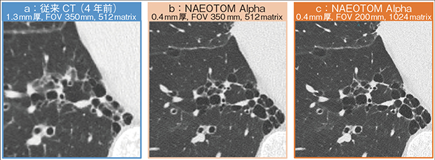 図5　症例3：間質性肺疾患症例における微細構造の視認性の向上